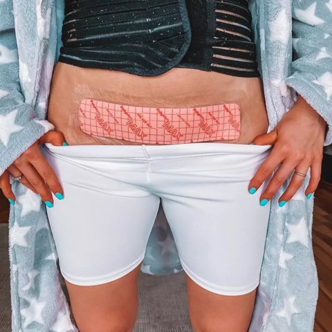 PAD PARA CESAREA POLYMEM - Imagen 2